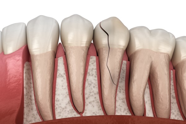 Can You Fix A Broken Tooth With A Dental Crown?