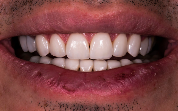 How A Dentist Can Repair A Broken Tooth And Restore Your Smile