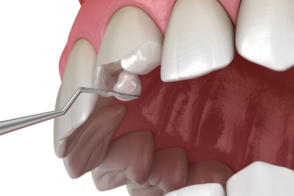 Treatment Options For A Chipped Tooth By A Cosmetic Dentist