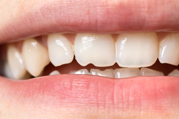 Reasons To Address A Chipped Tooth Immediately