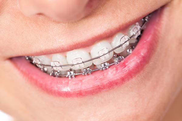 Benefits Of Clear Braces