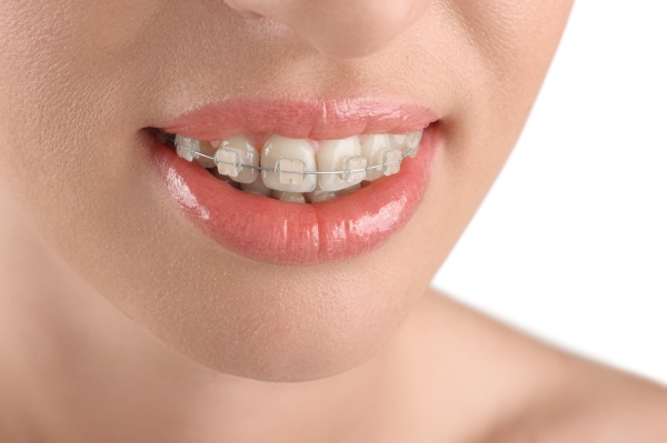 Why Should I Consider Clear Braces?