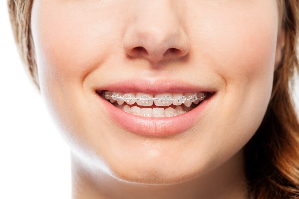 Why You Should Consider Clear Braces