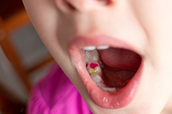 How Composite Fillings And Other Restorations Can Save Your Natural Teeth