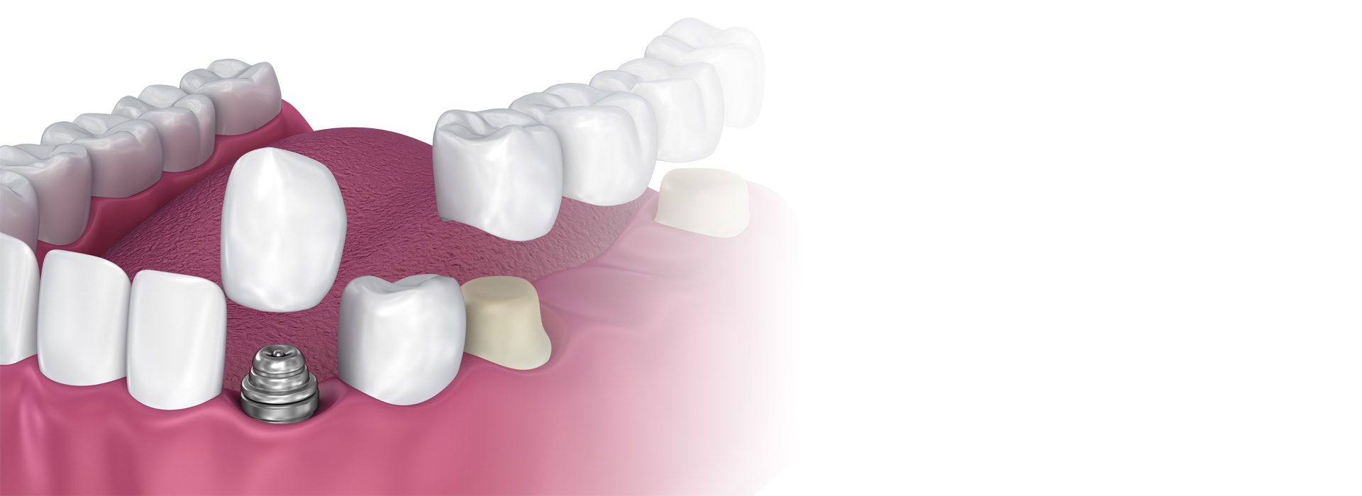 Implant Supported Dentures   
