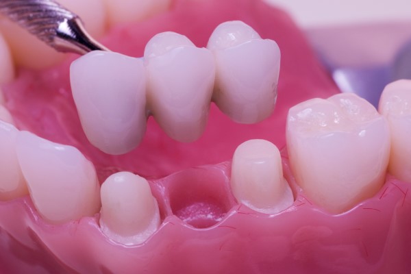 How Long Do Dental Bridges Last?