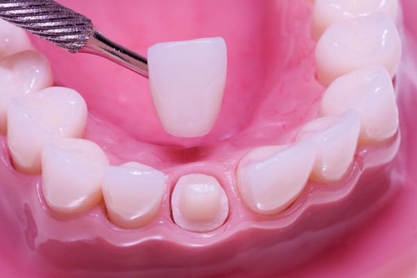 Damaged Tooth Repair With a Dental Crown - Frankford Dental Care