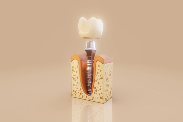 Proper Dental Implant Care In Your Oral Hygiene Routine