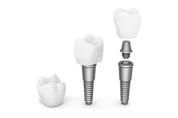 The   Parts Of Dental Implant Tooth Replacement