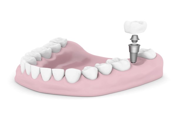 Should You Consider Getting Dental Implants?