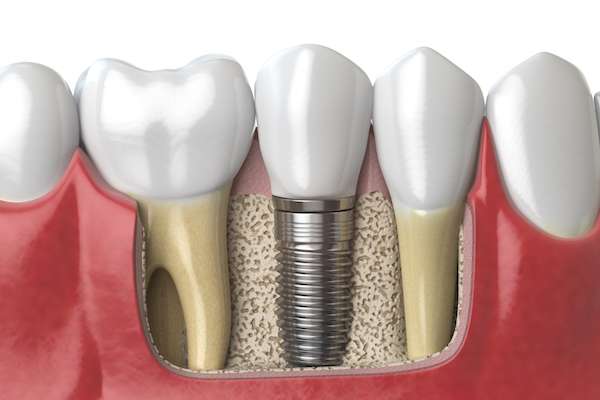 Dental Implants for Replacing Missing Teeth from Frankford Dental Care in Philadelphia, PA