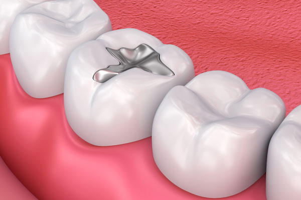 Dental Restorations: Choosing Between Fillings and Crowns from Frankford Dental Care in Philadelphia, PA