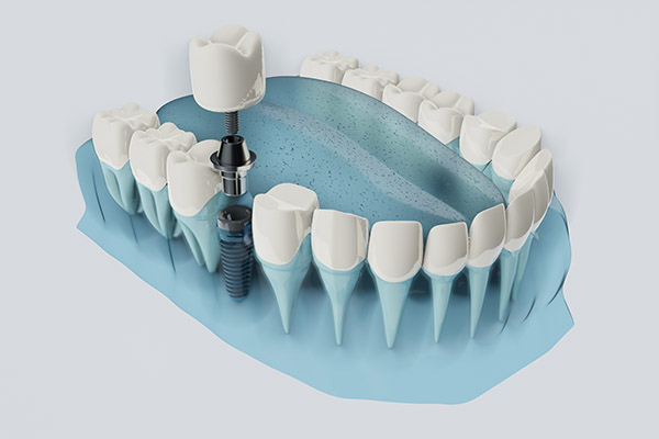 FAQs about Dental Implants from Frankford Dental Care in Philadelphia, PA