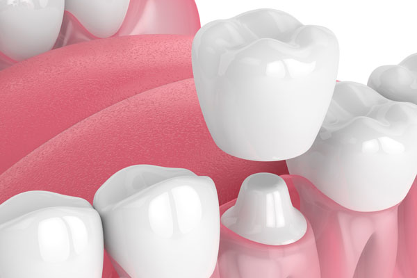 How Dentists Use Dental Crowns In Dental Restorations