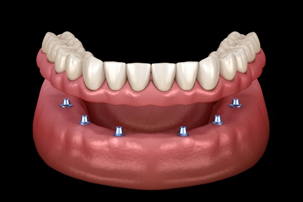 Comparing Implant Supported Dentures To Conventional