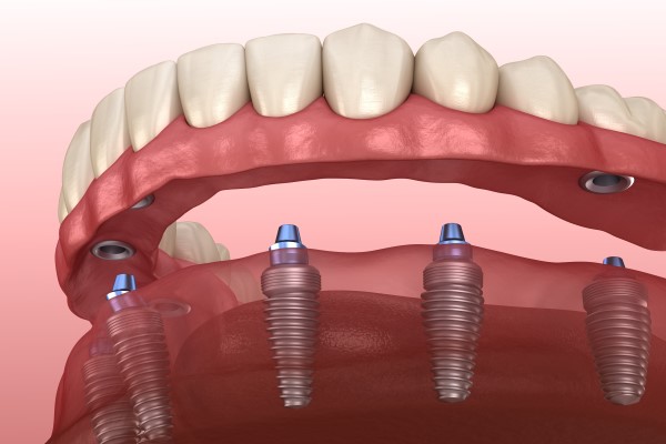 Differences Between Implant Supported Dentures And Traditional Dentures