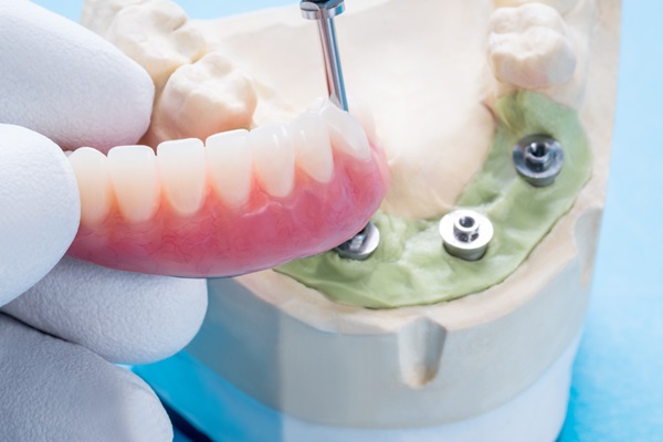 Implant Supported Dentures Guide: Process, Benefits, And Care