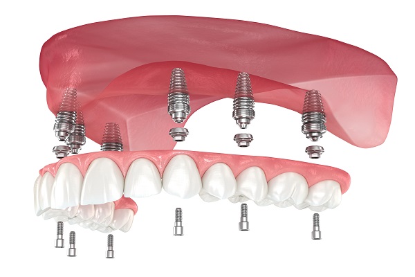Implant Supported Dentures: Secure, Comfortable, And Natural Looking Smiles