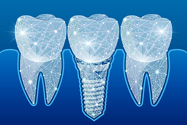 Preventing Complications After Getting Dental Implants from Frankford Dental Care in Philadelphia, PA