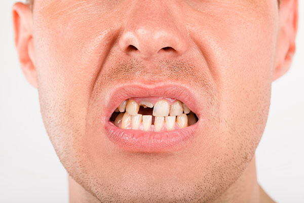 Which Dental Restorations Are Recommended For Damaged Teeth?