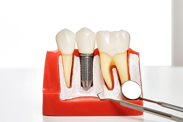 Your Guide To Different Kinds Of Dental Implants