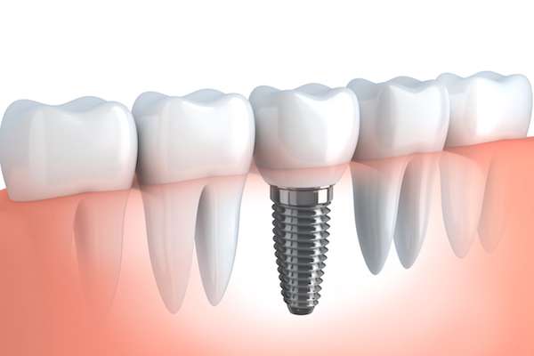 Your Ultimate Guide to Getting Dental Implants from Frankford Dental Care in Philadelphia, PA